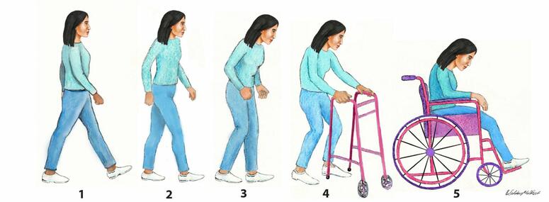 An image depicting the five stages of Parkinson's disease progression in women.