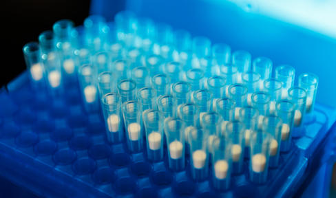 PPMI Data Shows Brain Changes Linked to Parkinson's Progression